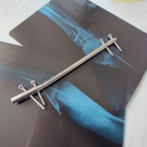 Interlocking Nails Implants