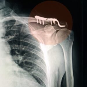 Rib, Pelvic, & Foot Implants